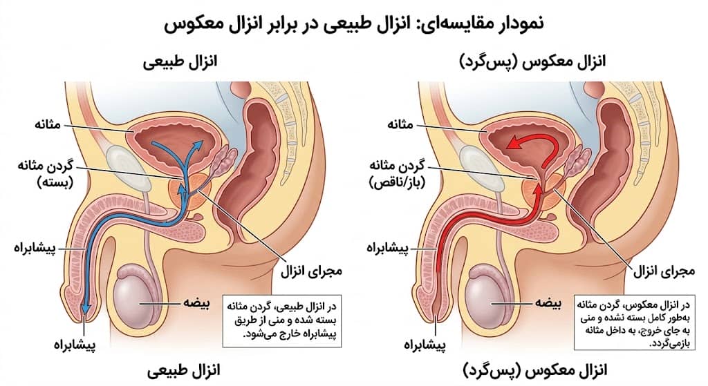 انزال معکوس