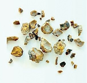 سنگ سیستئین