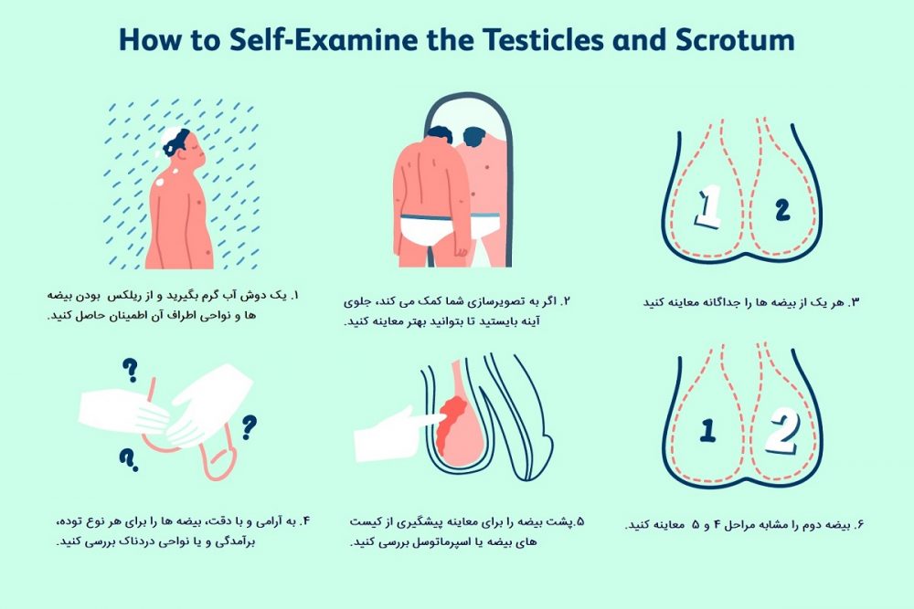 معاینه بیضه برای تشخیض اسپرماتوسل