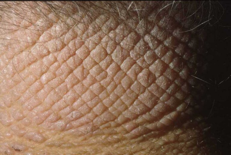 اگزما و درماتیت تماسی بیضه
