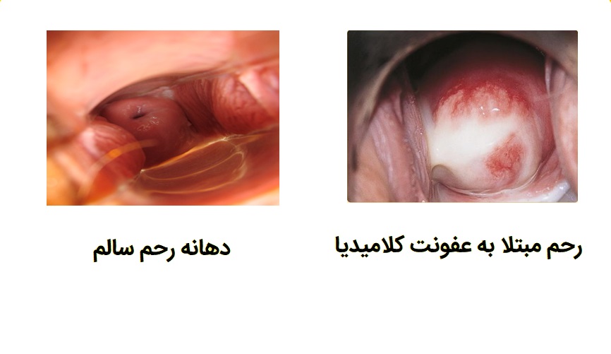 عفونت کلامیدیا دهانه رحم