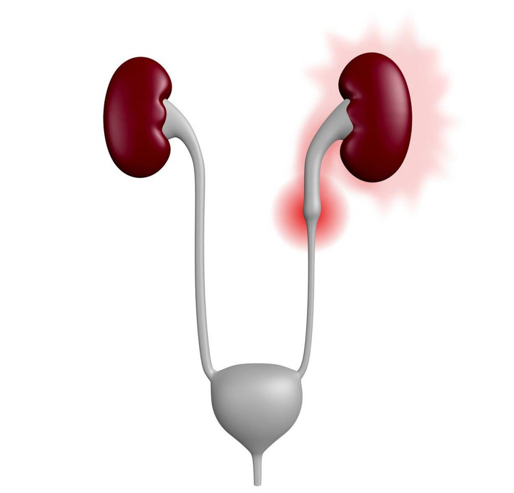 درمان سنگ گیر کرده در حالب