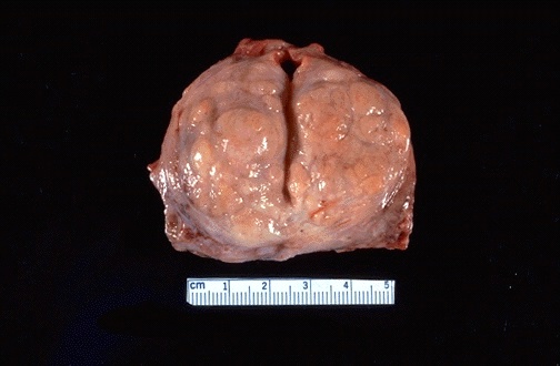 عکس پروستات 3
