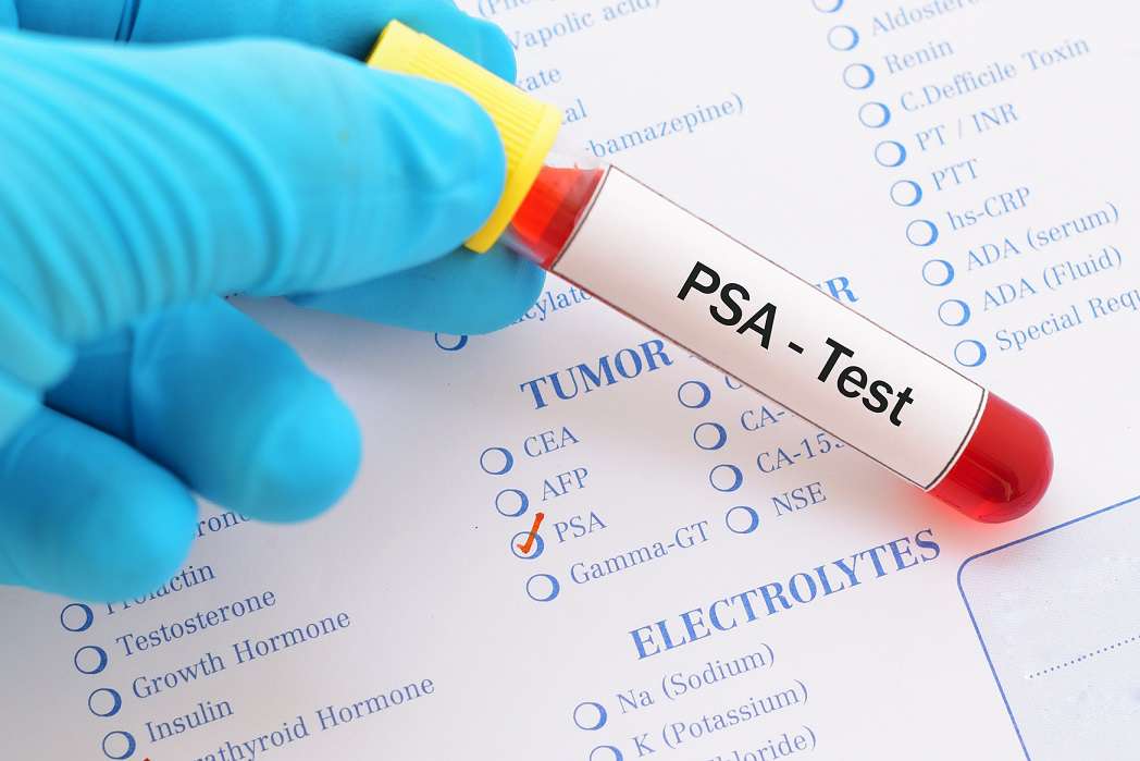 لوله‌ی آزمایش خون با برچسب PSA در دست تکنسین آزمایشگاه