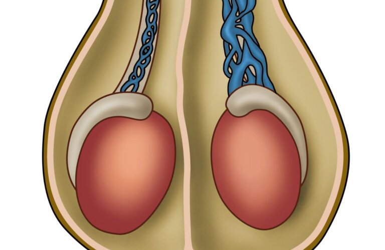 واریکوسل گرید 4