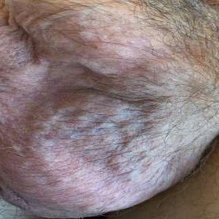 بیضه درگیر واریس