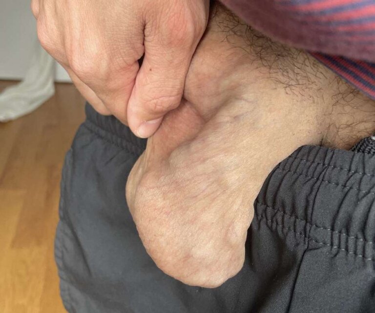 عکس واریس بیضه