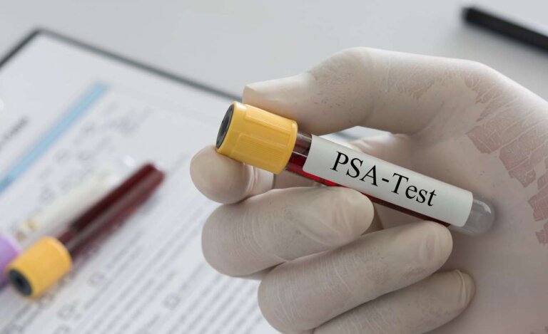 تست PSA