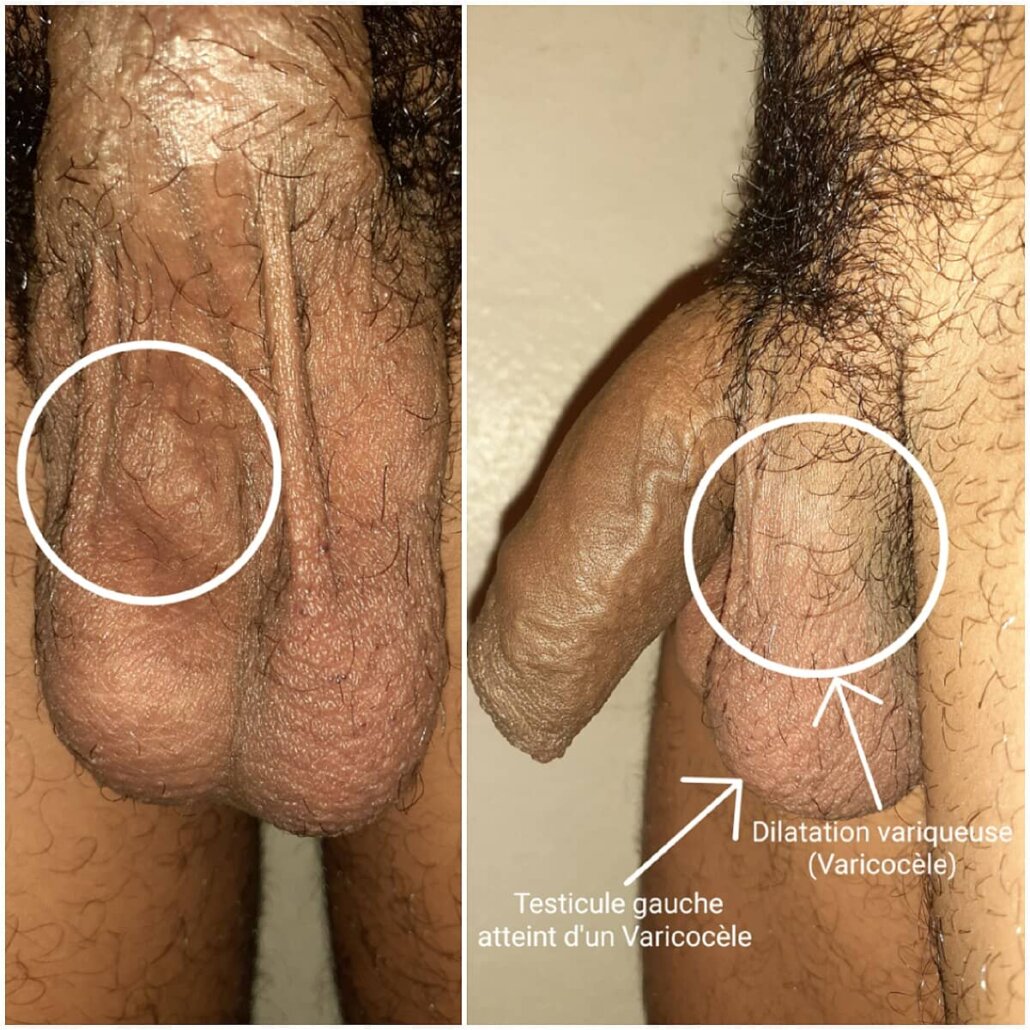 واریکوسل گرید ۲