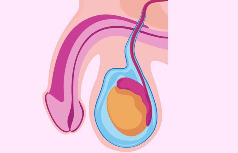 ایجاد هیدروسل (Hydrocele Formation) به عنوان عارضه ناخواسته