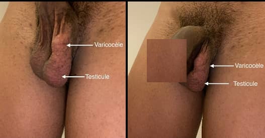 تصویر واریکوسل گرید ۳