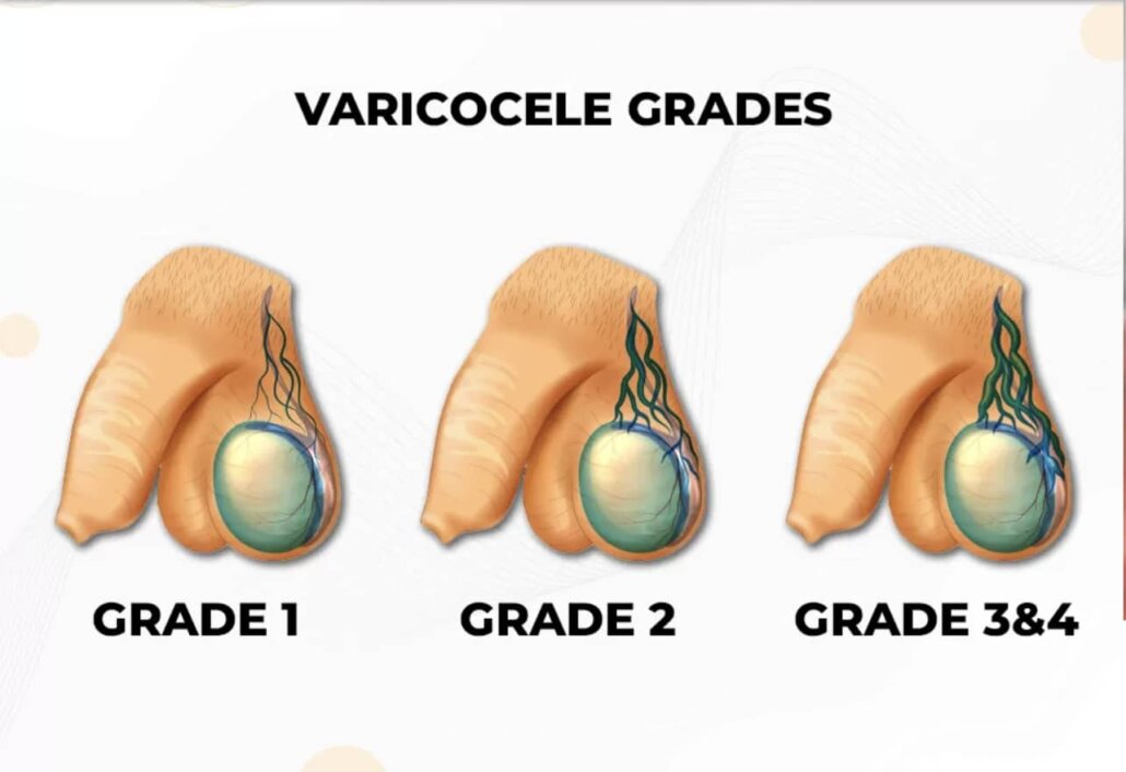 واریکوسل درجه ۱