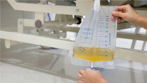 بی اختیاری ادرار بعد از کشیدن سوند