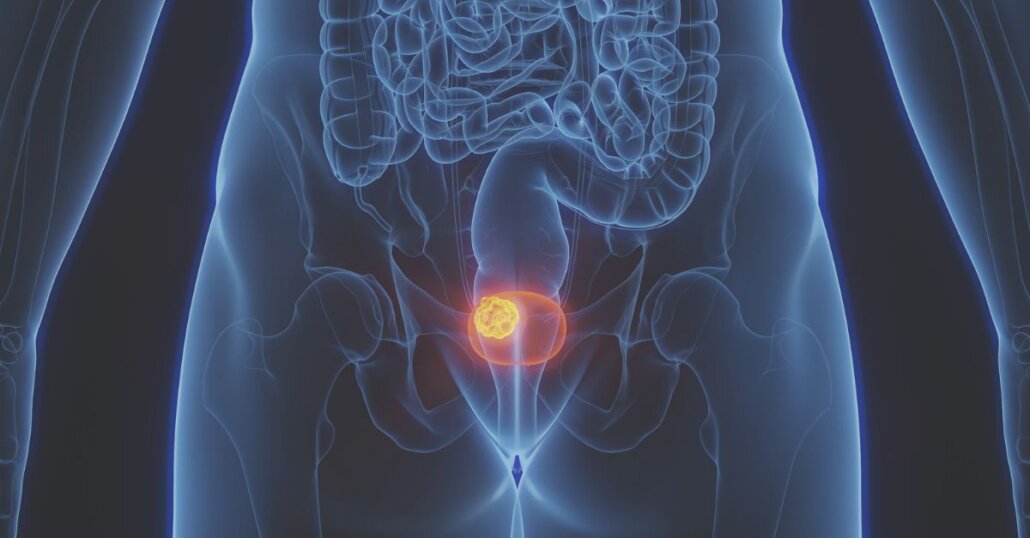 درمان سرطان مثانه