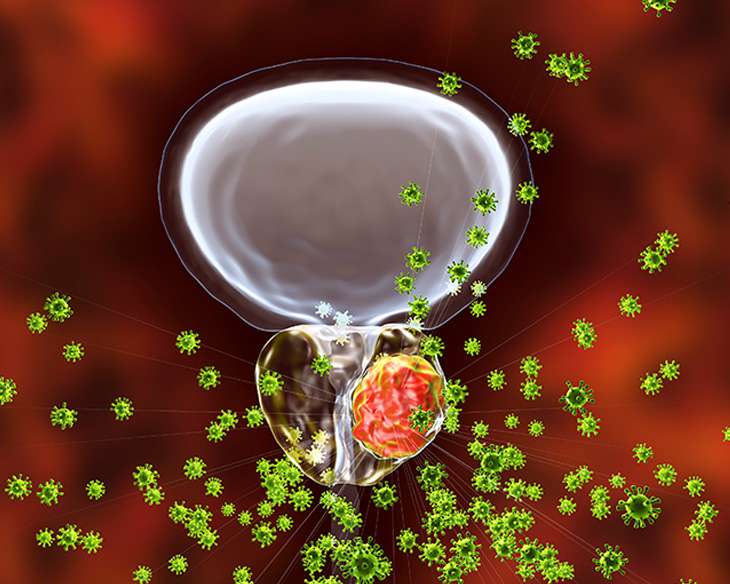 مراحل سرطان پروستات