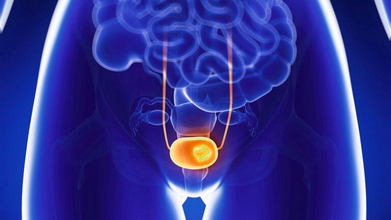مقایسه روش‌های درمانی سرطان مثانه