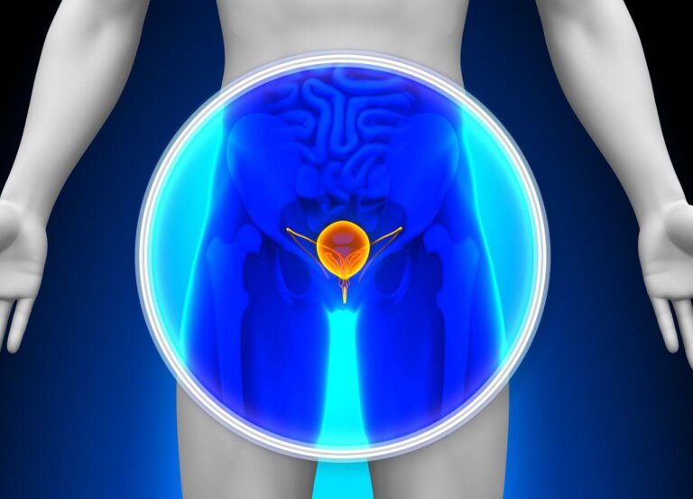 سرطان مثانه