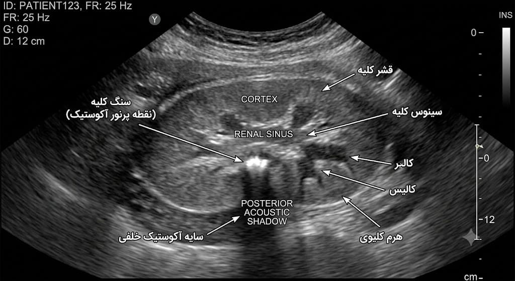 عکس سنگ کلیه در سونوگرافی