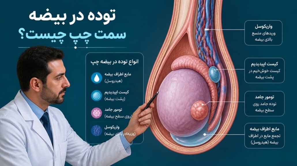 توده در بیضه سمت چپ
