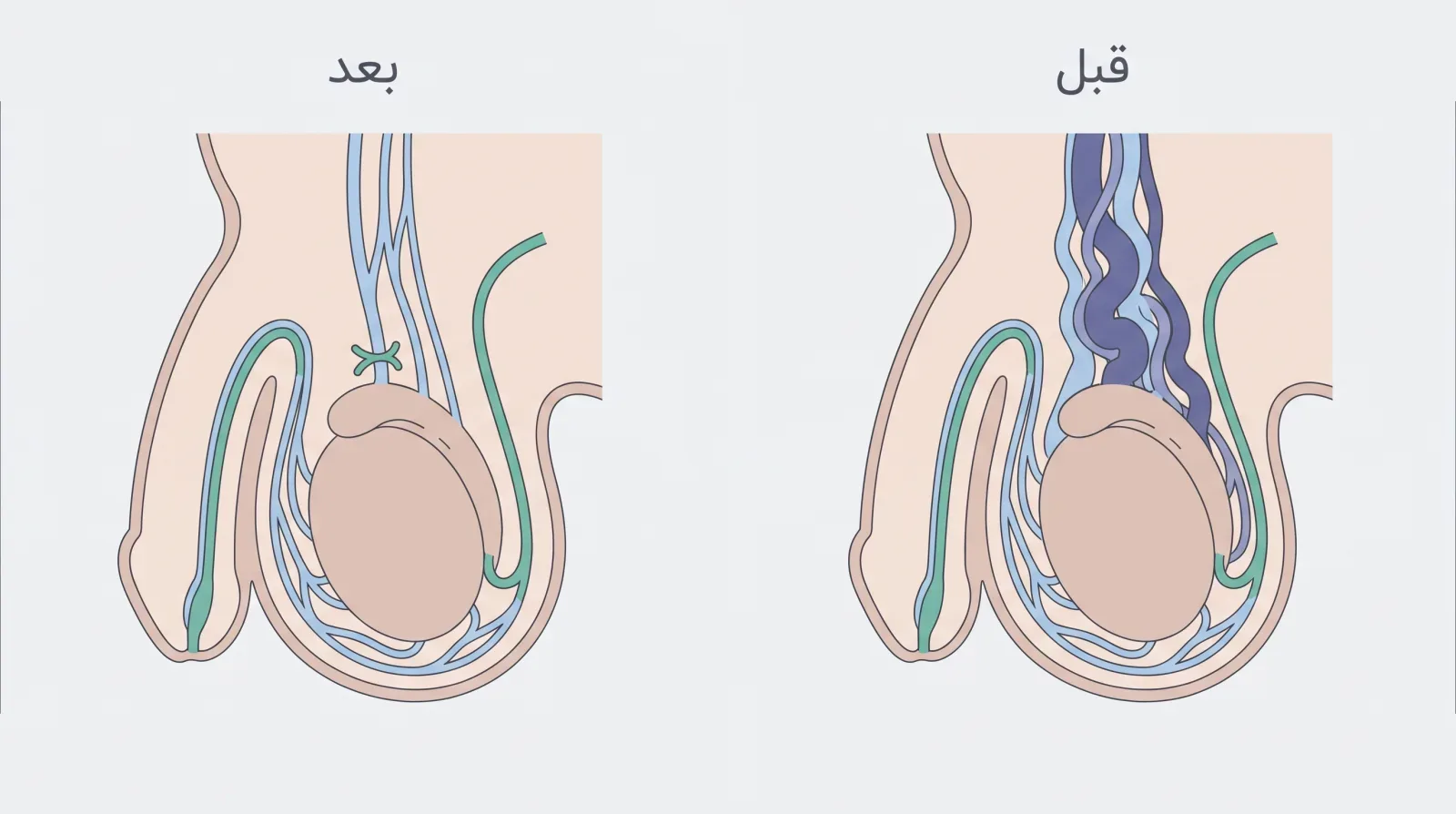 نمودار سادهی آناتومی بیضه و سیاهرگهای واریکوسل قبل و بعد از جراحی